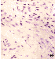 淋巴管平滑肌瘤