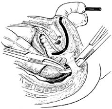 新生兒肛門和直腸畸形