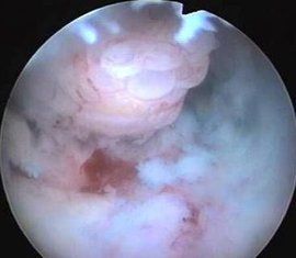 宮腔息肉 宮腔息肉