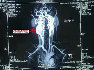（圖）頸部血管瘤