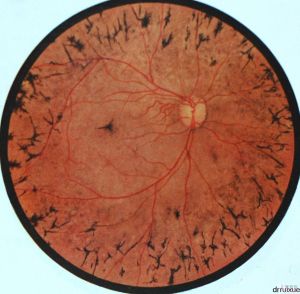 環狀視網膜變性