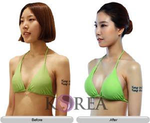 自然隆胸 自然隆胸