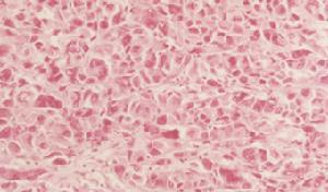 （圖）肛管直腸惡性黑色素瘤