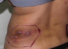 腰部包塊 腰部包塊