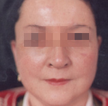 面部皺紋祛除術
