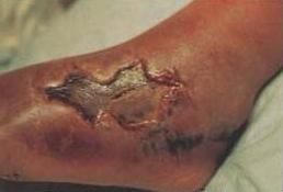 足部壞死性筋膜炎