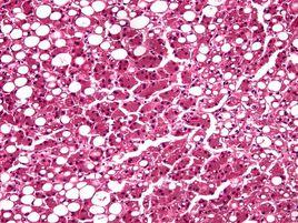 肝脂肪變性 肝脂肪變性