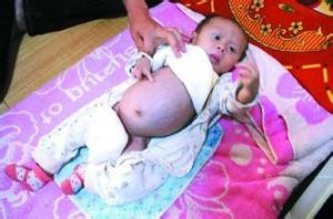 10月大男嬰腹部積水