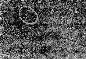 原發性食管惡性黑色素瘤