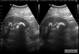 多發性腎結石 多發性腎結石