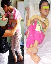 Lesch-Nyhan綜合症