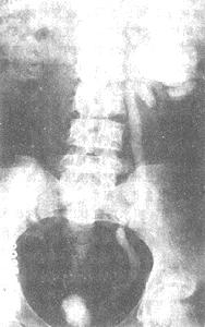 腎結核對側腎積水