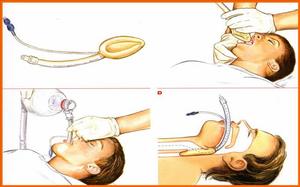 圖2 喉罩通氣道插入方法