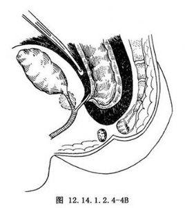 經會陰肛門成形術 經會陰肛門成形術