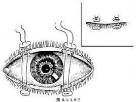 瞼緣縫合術 瞼緣縫合術