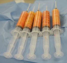 自體脂肪移植術 自體脂肪移植術