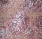 頭皮型銀屑病 頭皮型銀屑病