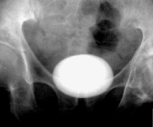 膀胱與尿道結石