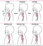 先天性食管狹窄