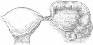 （圖）卵巢殘餘綜合徵