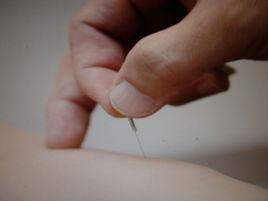 《針灸治療頸椎病》 《針灸治療頸椎病》