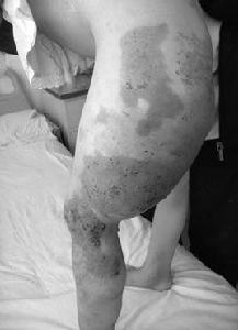 KT綜合症 KT綜合症