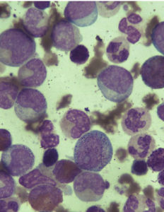 慢性粒細胞白血病