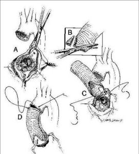 胸主動脈夾層動脈瘤