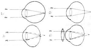 泡性角結膜炎 泡性角結膜炎