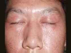 顏面復發性皮炎 顏面復發性皮炎