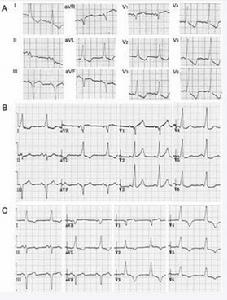 心肌梗死后綜合征心電圖