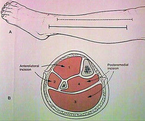 筋膜間隔區綜合徵 筋膜間隔區綜合徵