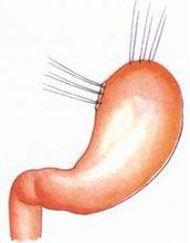 示意圖4:在距脾胃韌帶1cm處縫合3針牽引線