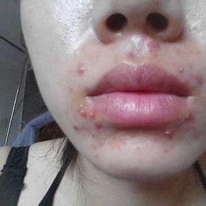 面部激素依賴性皮炎 面部激素依賴性皮炎