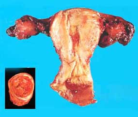 （圖）子宮頸殘端癌