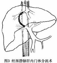 圖3 門脈高壓症