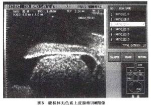 睫狀體黑色素瘤