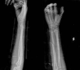 尺橈骨雙骨折切開復位內固定術 尺橈骨雙骨折切開復位內固定術