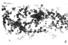 噬血細胞綜合徵 噬血細胞綜合徵