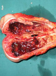 橫紋肌肉瘤 橫紋肌肉瘤