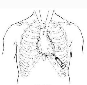 心包穿刺術 心包穿刺術
