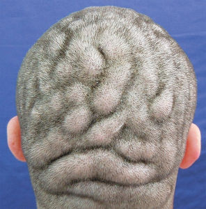 回狀頭皮 回狀頭皮