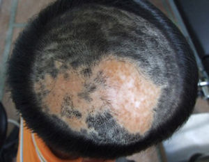 疤痕性脫髮 疤痕性脫髮