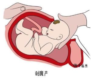 刨宮產 刨宮產