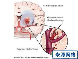 腦血管爆裂 腦血管爆裂