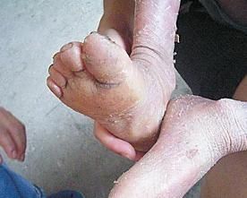 皮膚粗糙 皮膚粗糙