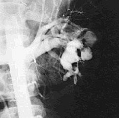 腎動靜脈瘺 腎動靜脈瘺