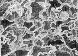 （圖）肛周腫瘤