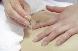 中醫穴位埋線減肥療法