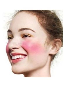 面部紅血絲 面部紅血絲